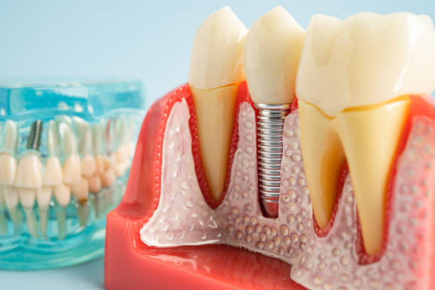 Best Dental Fillings (Composite and Amalgam)  in Columbus, OH